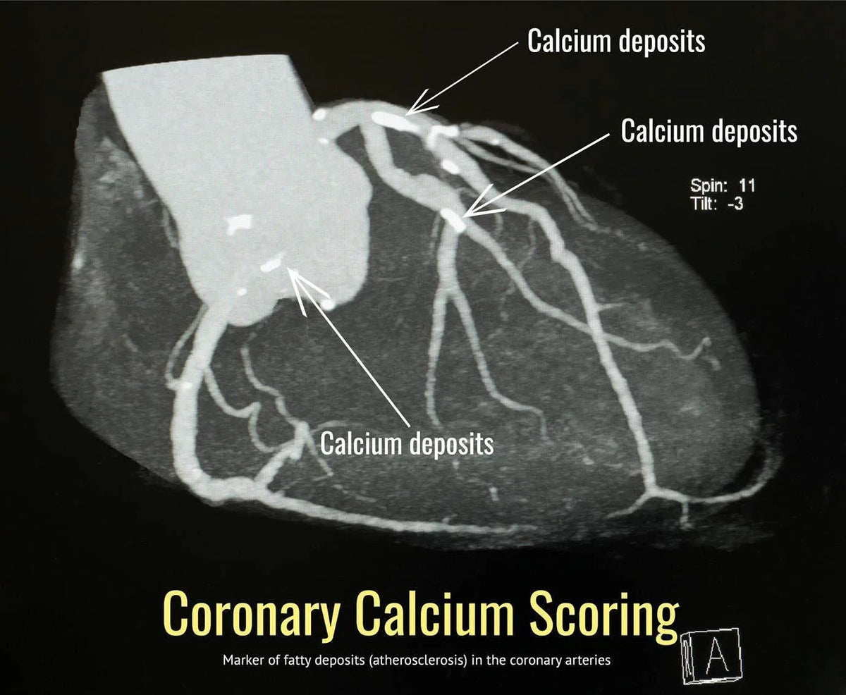 CT scan showing coronary arteries with labeled calcium deposits, coronary calcium scoring